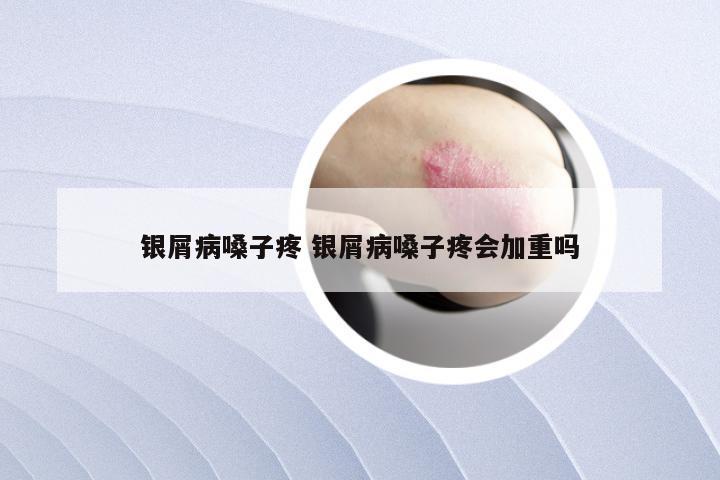 银屑病嗓子疼 银屑病嗓子疼会加重吗