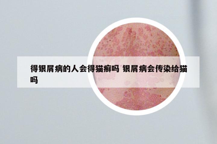 得银屑病的人会得猫癣吗 银屑病会传染给猫吗