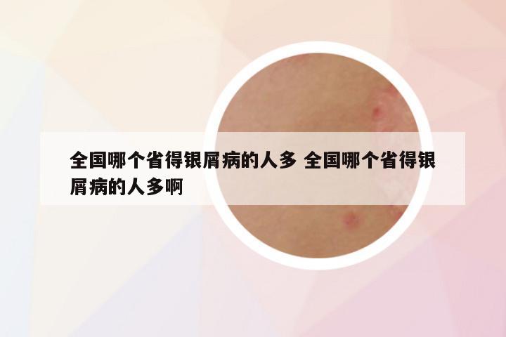 全国哪个省得银屑病的人多 全国哪个省得银屑病的人多啊