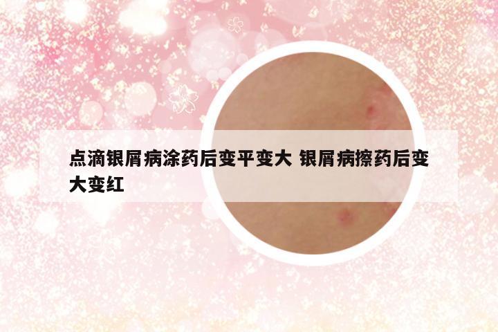 点滴银屑病涂药后变平变大 银屑病擦药后变大变红