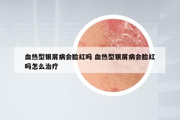 血热型银屑病会脸红吗 血热型银屑病会脸红吗怎么治疗