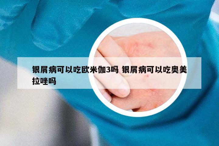 银屑病可以吃欧米伽3吗 银屑病可以吃奥美拉唑吗