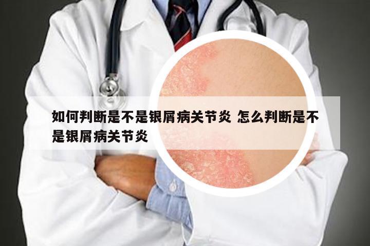 如何判断是不是银屑病关节炎 怎么判断是不是银屑病关节炎