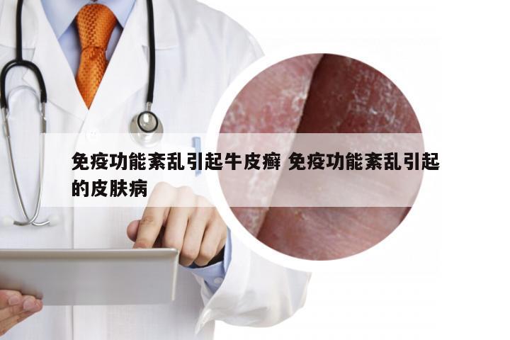 免疫功能紊乱引起牛皮癣 免疫功能紊乱引起的皮肤病