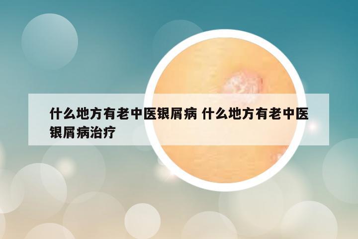什么地方有老中医银屑病 什么地方有老中医银屑病治疗