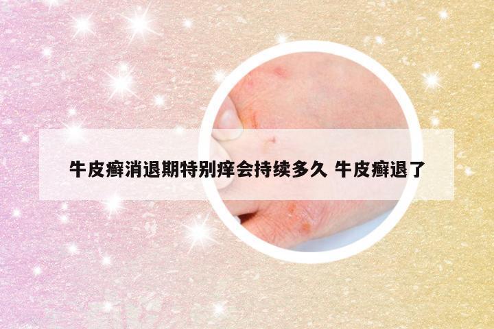 牛皮癣消退期特别痒会持续多久 牛皮癣退了