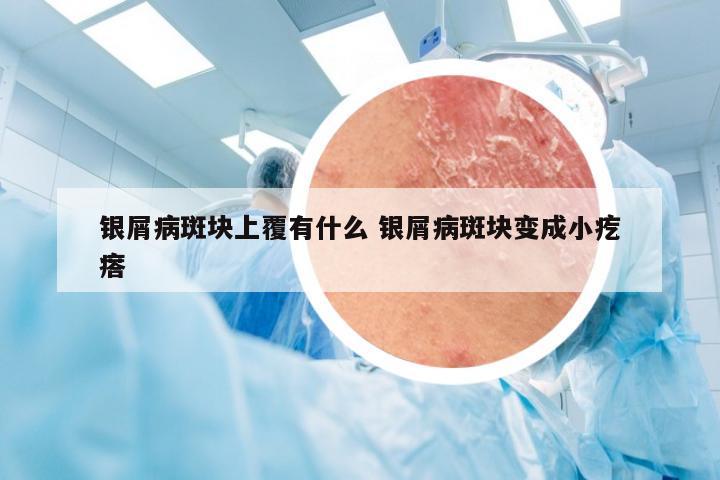 银屑病斑块上覆有什么 银屑病斑块变成小疙瘩
