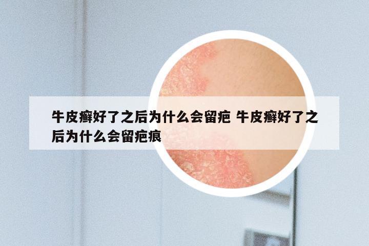 牛皮癣好了之后为什么会留疤 牛皮癣好了之后为什么会留疤痕