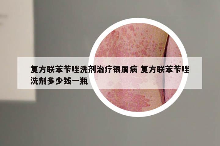 复方联苯苄唑洗剂治疗银屑病 复方联苯苄唑洗剂多少钱一瓶