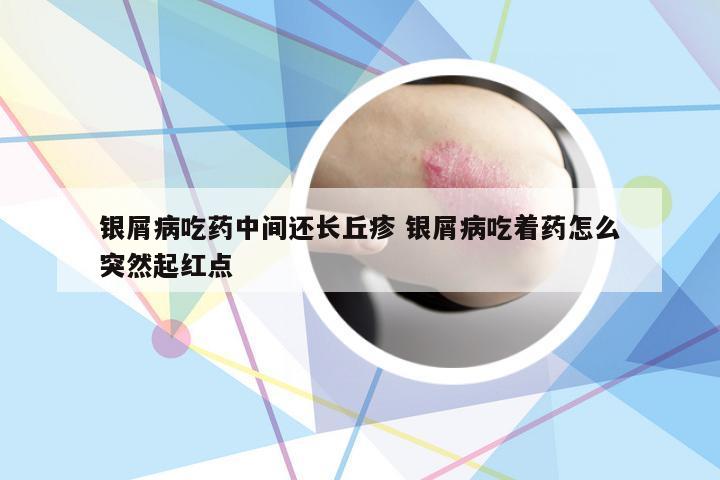 银屑病吃药中间还长丘疹 银屑病吃着药怎么突然起红点