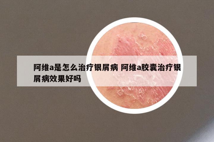 阿维a是怎么治疗银屑病 阿维a胶囊治疗银屑病效果好吗