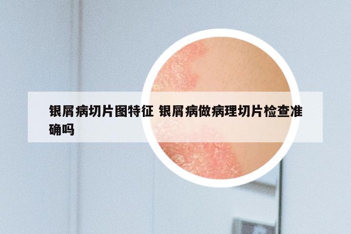 银屑病切片图特征 银屑病做病理切片检查准确吗