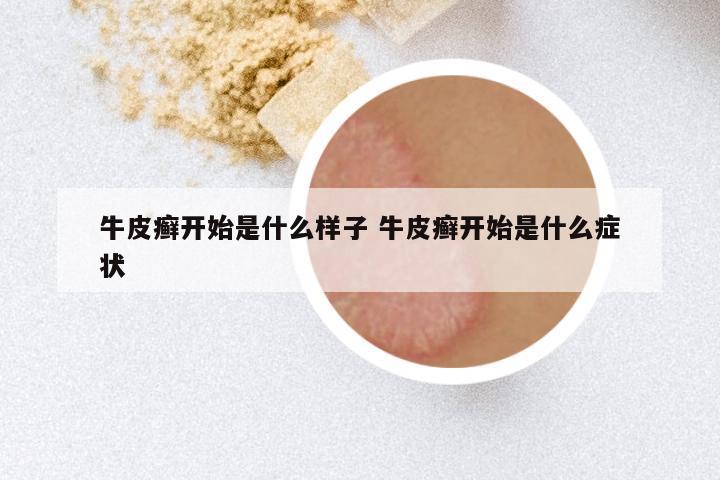 牛皮癣开始是什么样子 牛皮癣开始是什么症状