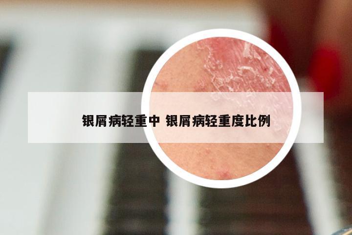 银屑病轻重中 银屑病轻重度比例