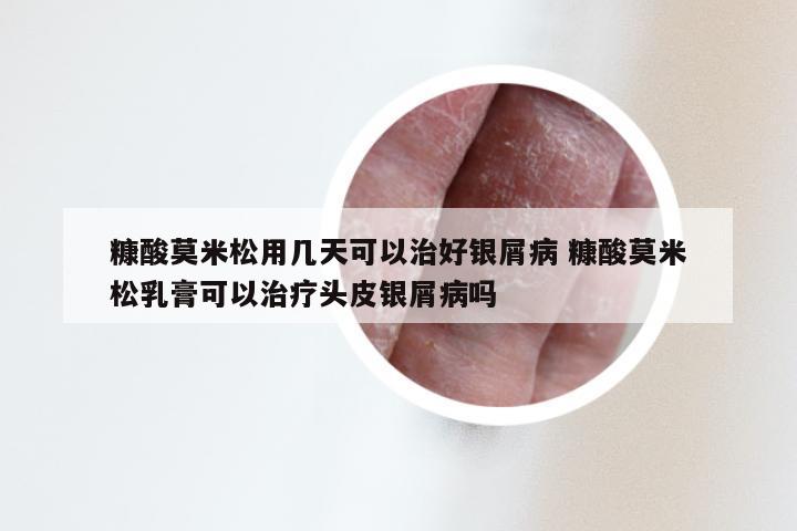 糠酸莫米松用几天可以治好银屑病 糠酸莫米松乳膏可以治疗头皮银屑病吗