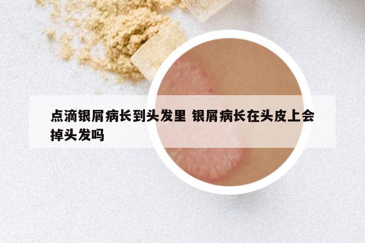 点滴银屑病长到头发里 银屑病长在头皮上会掉头发吗