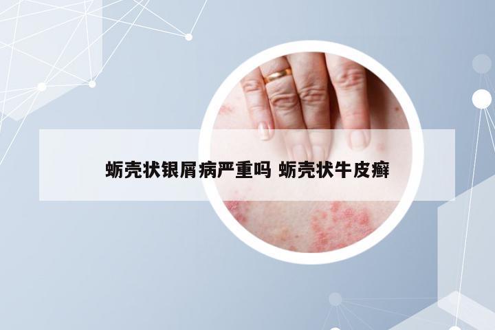 蛎壳状银屑病严重吗 蛎壳状牛皮癣