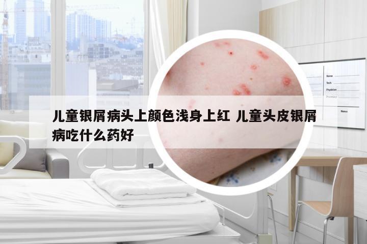 儿童银屑病头上颜色浅身上红 儿童头皮银屑病吃什么药好