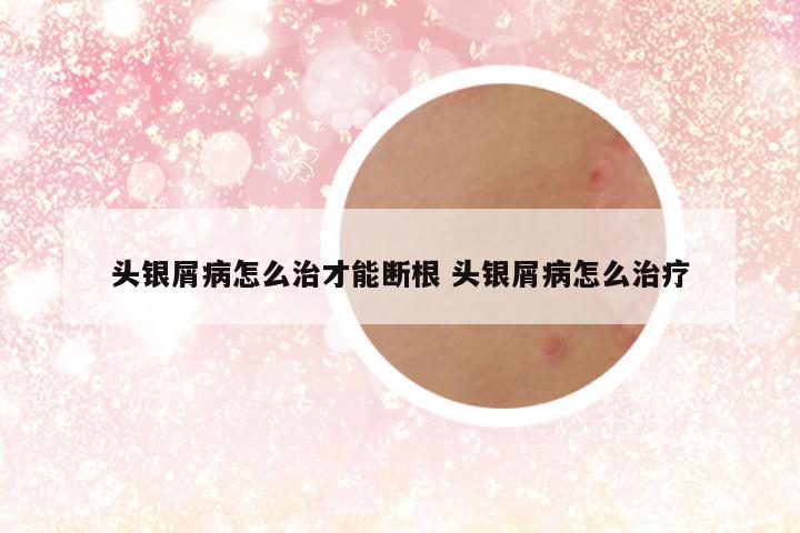 头银屑病怎么治才能断根 头银屑病怎么治疗