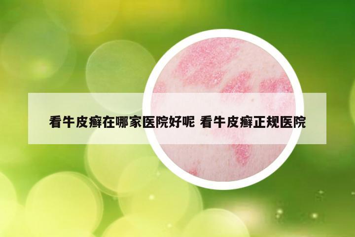 看牛皮癣在哪家医院好呢 看牛皮癣正规医院