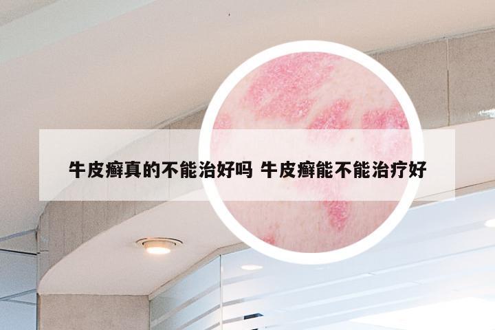 牛皮癣真的不能治好吗 牛皮癣能不能治疗好
