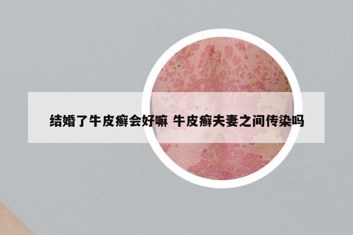 结婚了牛皮癣会好嘛 牛皮癣夫妻之间传染吗