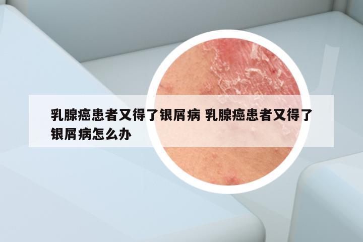 乳腺癌患者又得了银屑病 乳腺癌患者又得了银屑病怎么办