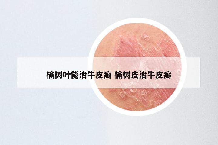 榆树叶能治牛皮癣 榆树皮治牛皮癣