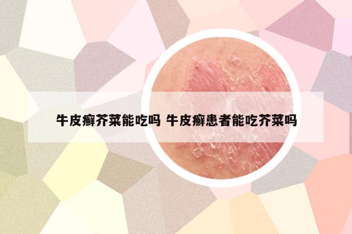 牛皮癣芥菜能吃吗 牛皮癣患者能吃芥菜吗