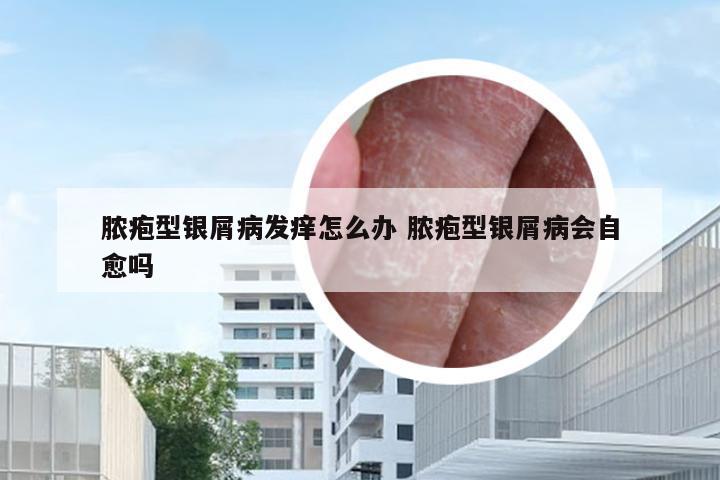 脓疱型银屑病发痒怎么办 脓疱型银屑病会自愈吗