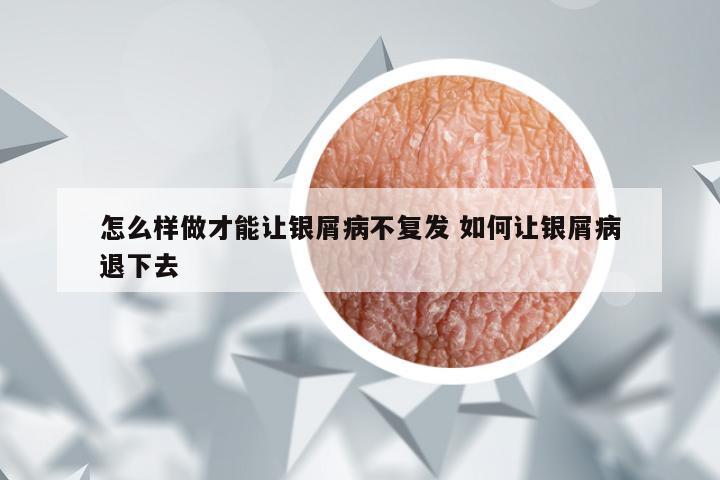 怎么样做才能让银屑病不复发 如何让银屑病退下去
