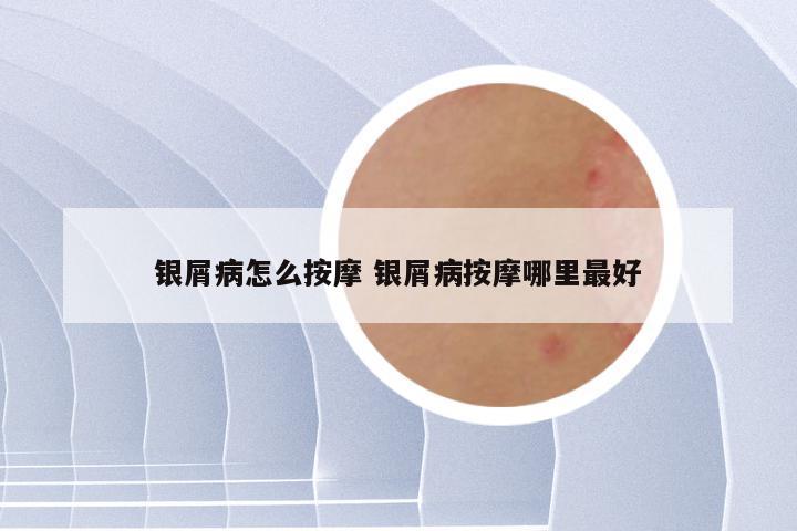 银屑病怎么按摩 银屑病按摩哪里最好