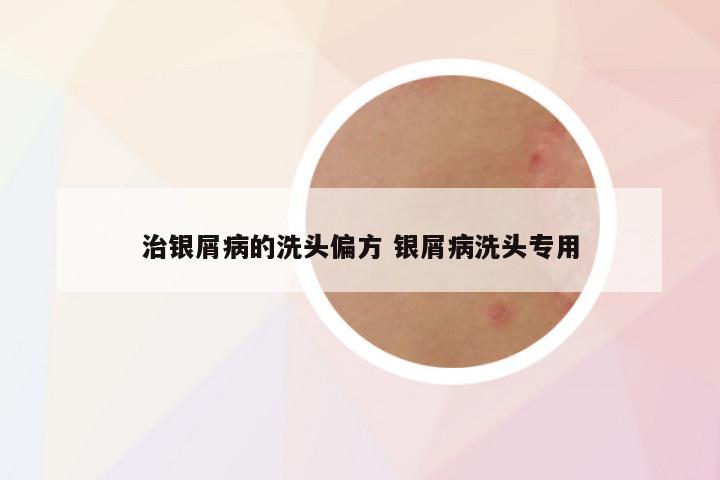 治银屑病的洗头偏方 银屑病洗头专用