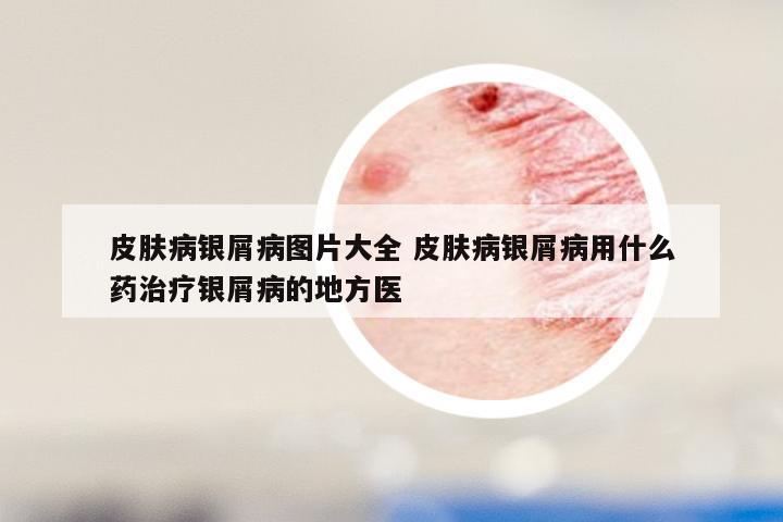 皮肤病银屑病图片大全 皮肤病银屑病用什么药治疗银屑病的地方医