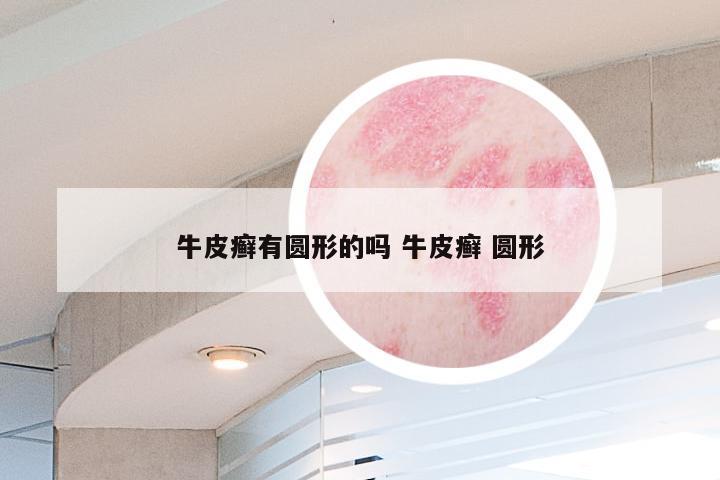 牛皮癣有圆形的吗 牛皮癣 圆形
