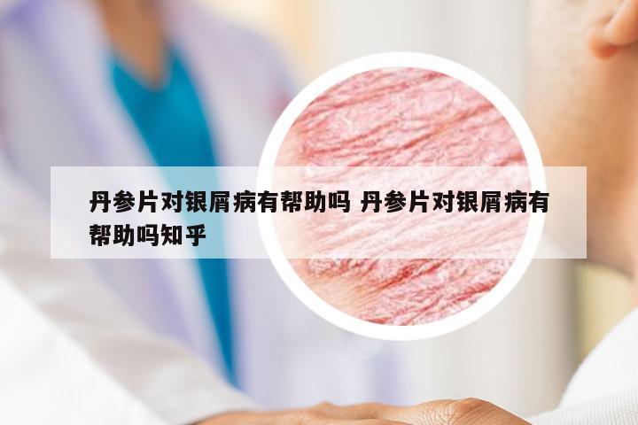 丹参片对银屑病有帮助吗 丹参片对银屑病有帮助吗知乎