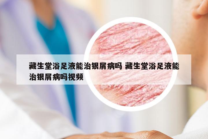藏生堂浴足液能治银屑病吗 藏生堂浴足液能治银屑病吗视频