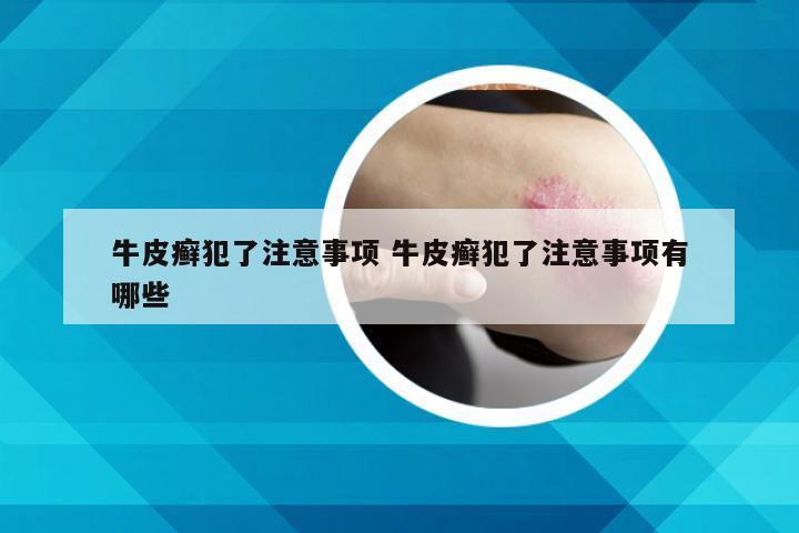 牛皮癣犯了注意事项 牛皮癣犯了注意事项有哪些