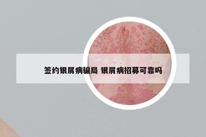 签约银屑病骗局 银屑病招募可靠吗