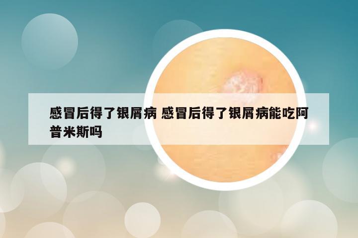 感冒后得了银屑病 感冒后得了银屑病能吃阿普米斯吗