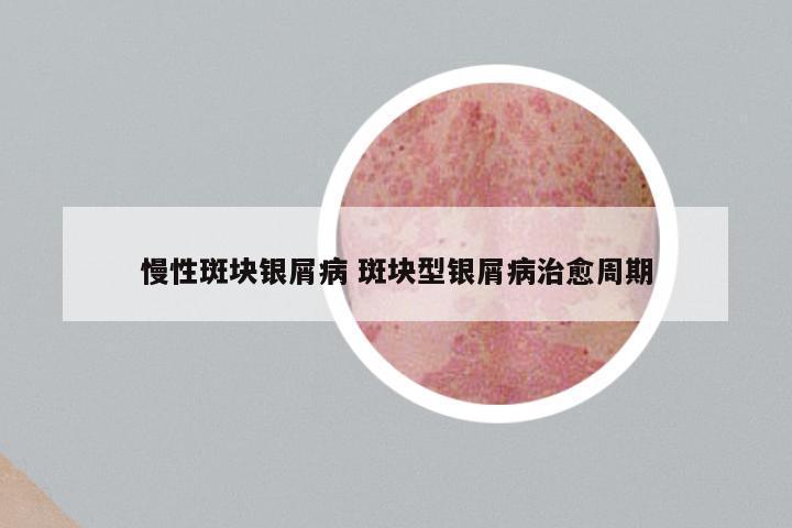 慢性斑块银屑病 斑块型银屑病治愈周期