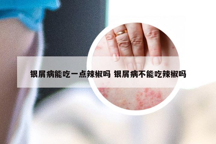 银屑病能吃一点辣椒吗 银屑病不能吃辣椒吗