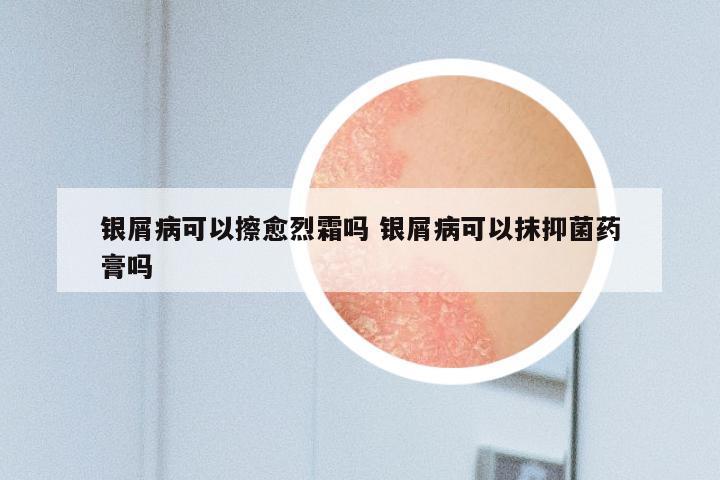银屑病可以擦愈烈霜吗 银屑病可以抹抑菌药膏吗
