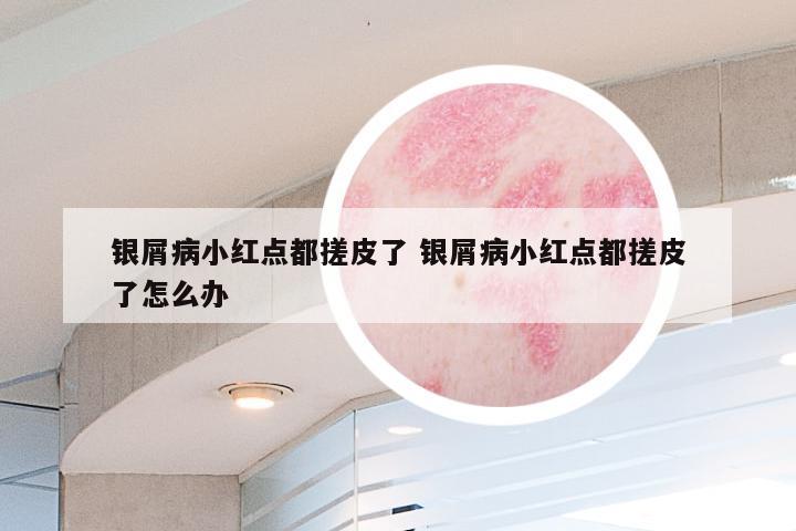银屑病小红点都搓皮了 银屑病小红点都搓皮了怎么办