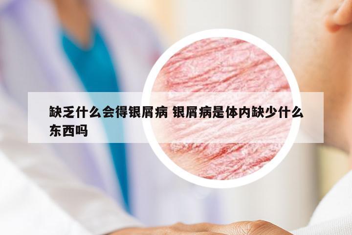 缺乏什么会得银屑病 银屑病是体内缺少什么东西吗