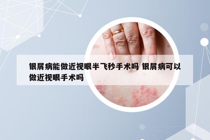 银屑病能做近视眼半飞秒手术吗 银屑病可以做近视眼手术吗