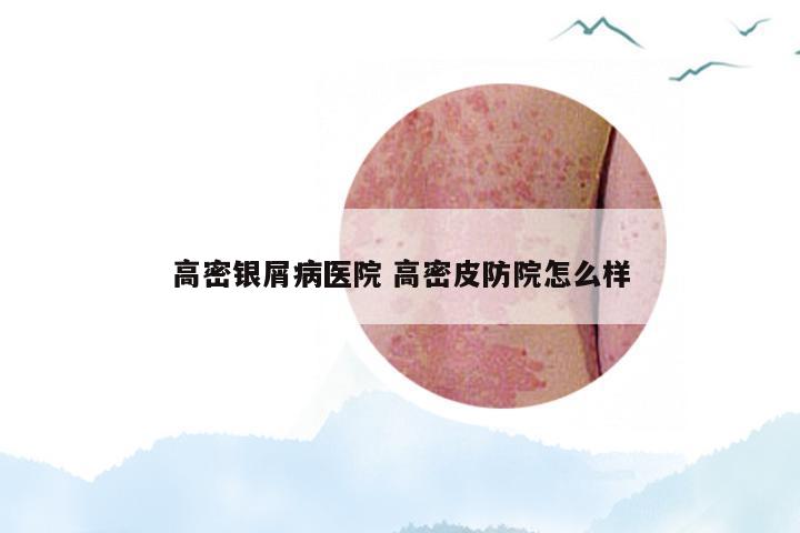 高密银屑病医院 高密皮防院怎么样