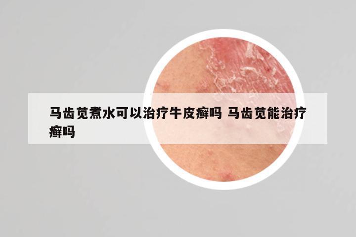 马齿苋煮水可以治疗牛皮癣吗 马齿苋能治疗癣吗