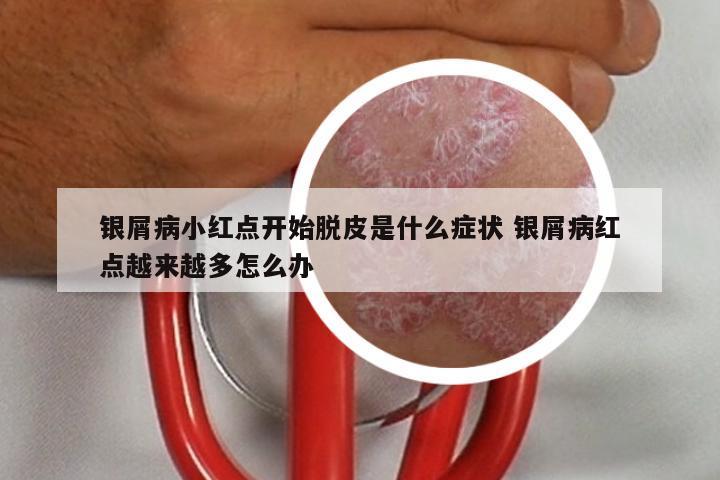 银屑病小红点开始脱皮是什么症状 银屑病红点越来越多怎么办