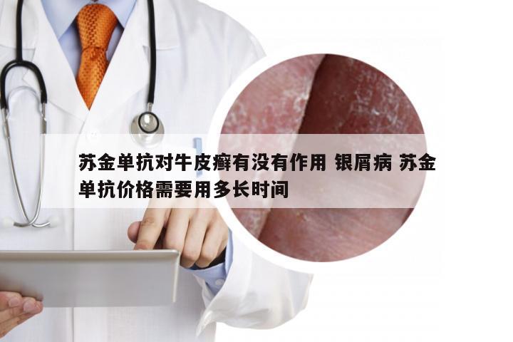 苏金单抗对牛皮癣有没有作用 银屑病 苏金单抗价格需要用多长时间